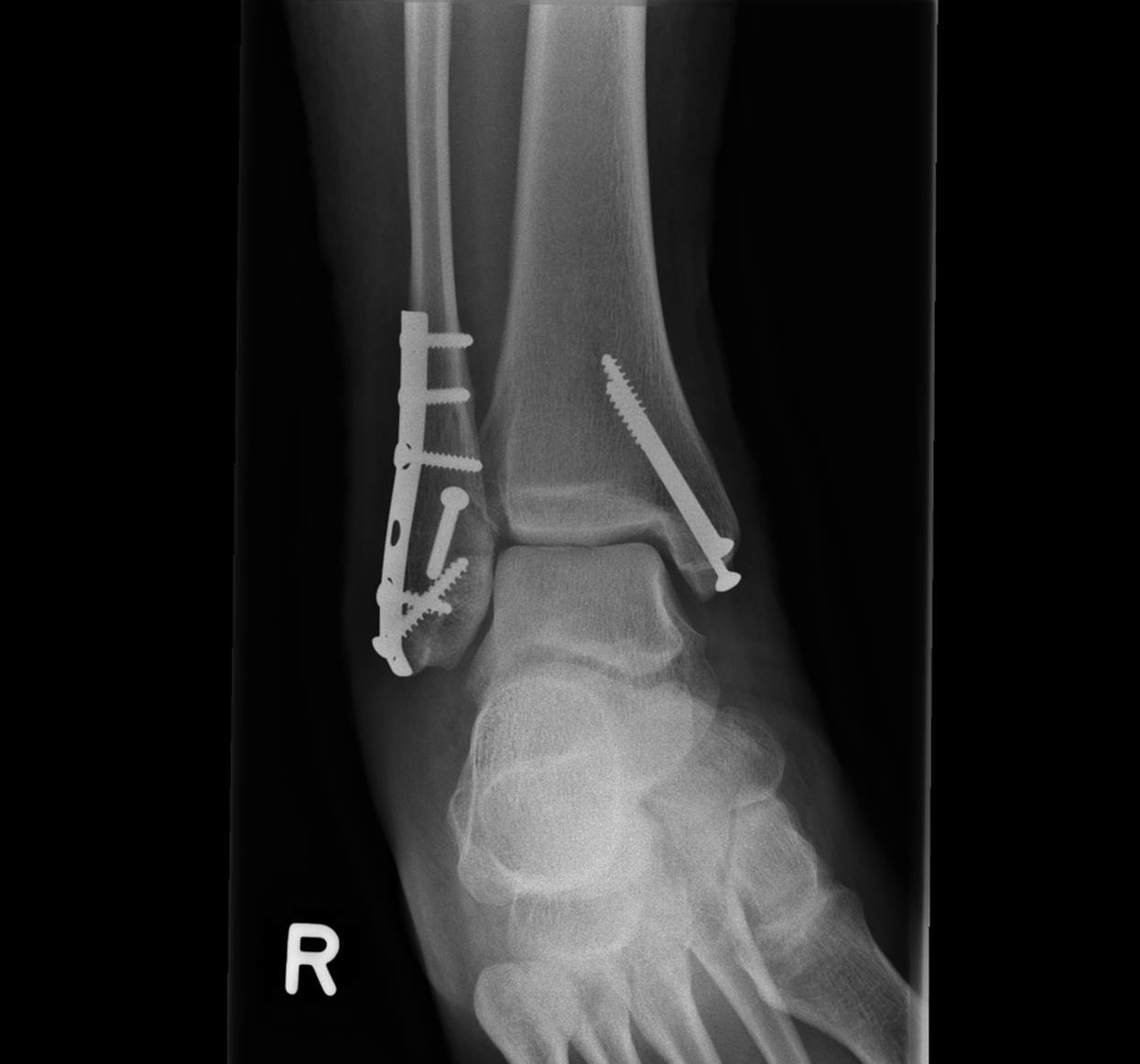 Fuß gebrochen wie lange gips